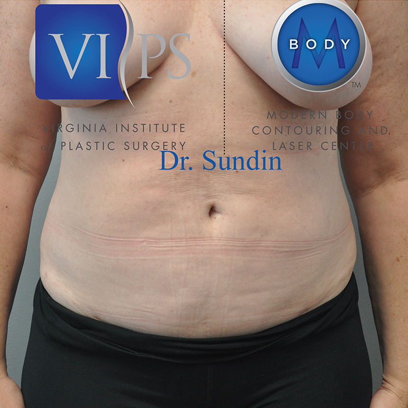 What is Liposuction?