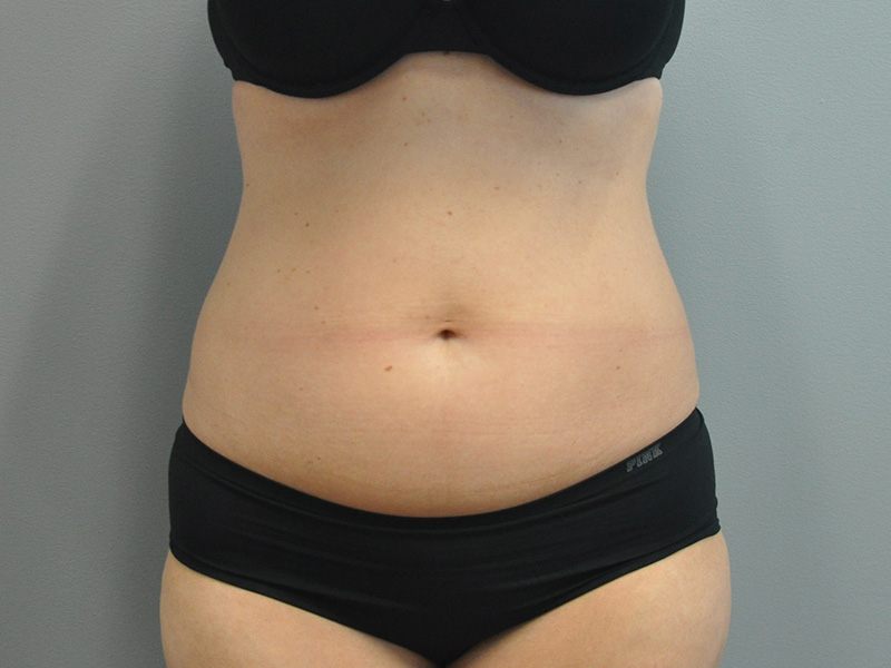 Liposuction Before and After | Little Lipo