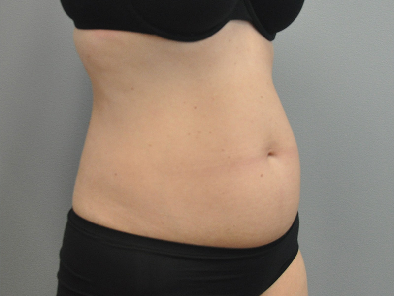 Liposuction Before and After | Little Lipo