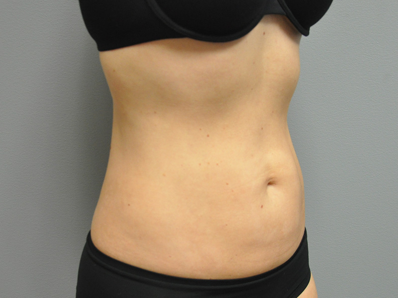 Liposuction Before and After | Little Lipo