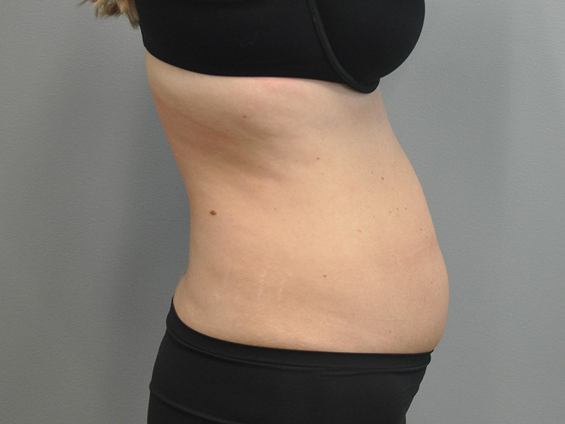 Liposuction Before and After | Little Lipo