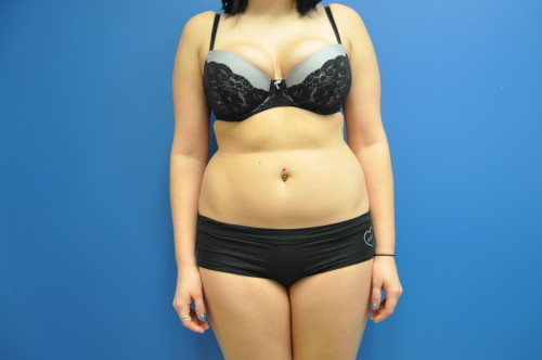 SmartLipo