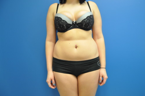 SmartLipo Richmond