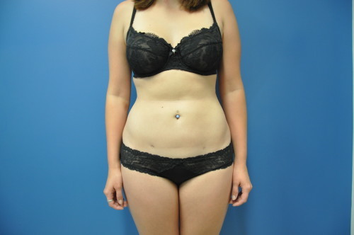 SmartLipo