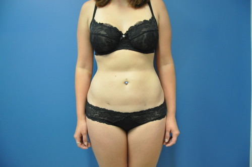 SmartLipo Richmond