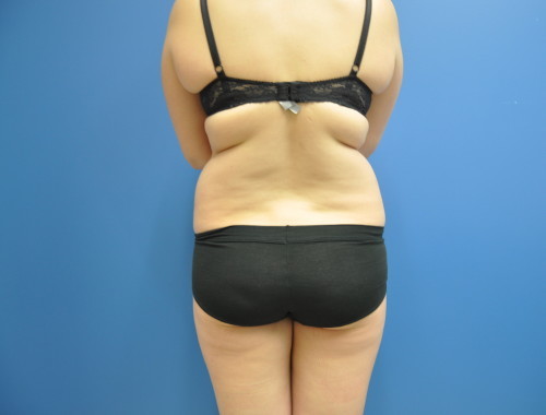 Liposuction Before and After | Little Lipo