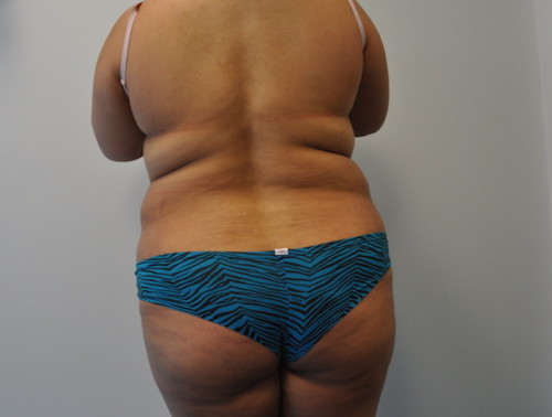 Liposuction Before and After | Little Lipo