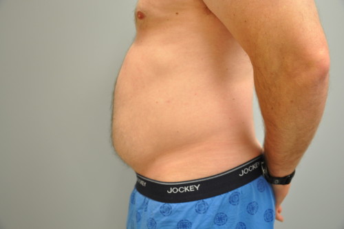 Liposuction Before and After | Little Lipo