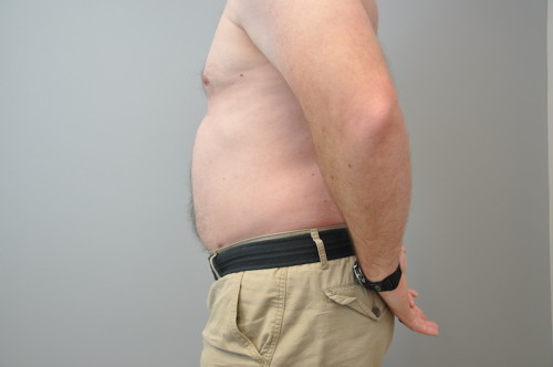Liposuction Before and After | Little Lipo
