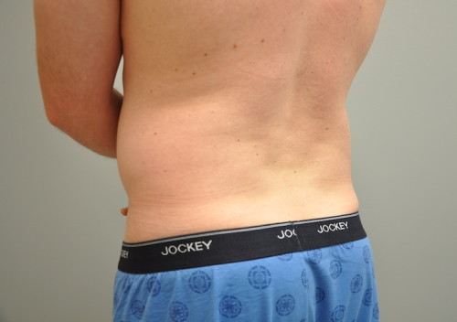 Liposuction Before and After | Little Lipo