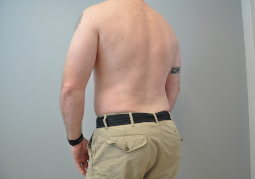 Liposuction Before and After | Little Lipo