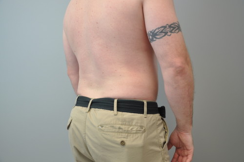 Liposuction Before and After | Little Lipo