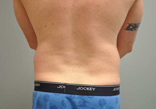 Liposuction Before and After | Little Lipo
