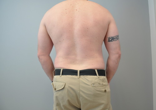 Liposuction Before and After | Little Lipo