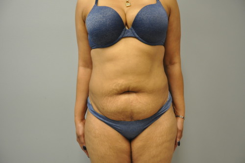 Assisted Liposuction Richmond