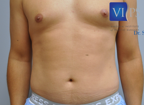 Assisted Liposuction Richmond