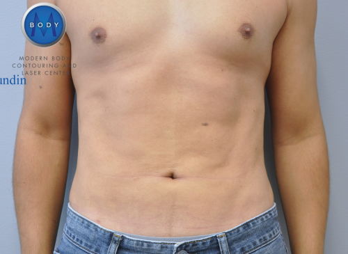 Liposuction Before and After | Little Lipo