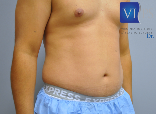 Liposuction Before and After | Little Lipo