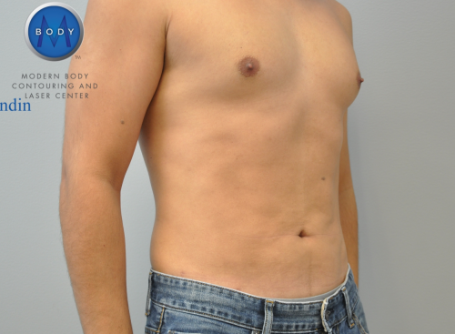Liposuction Before and After | Little Lipo
