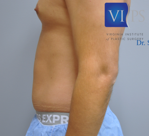 Liposuction Before and After | Little Lipo