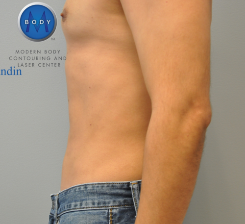 Liposuction Before and After | Little Lipo