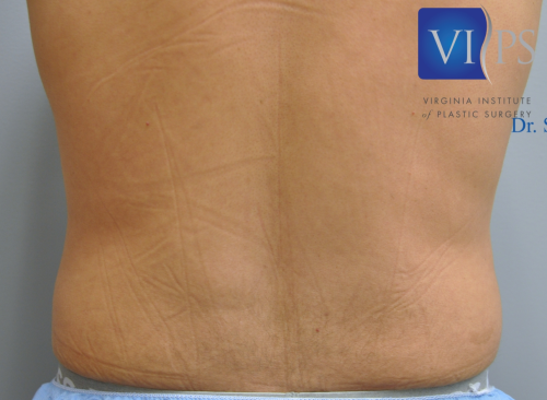 Liposuction Before and After | Little Lipo