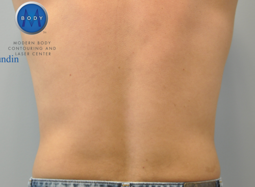 Liposuction Before and After | Little Lipo