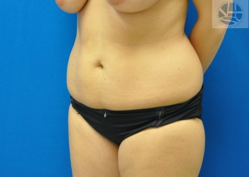 Hip Liposuction Richmond