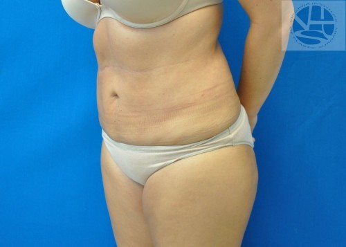 Hip Liposuction Richmond