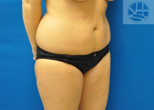 Liposuction Before and After | Little Lipo