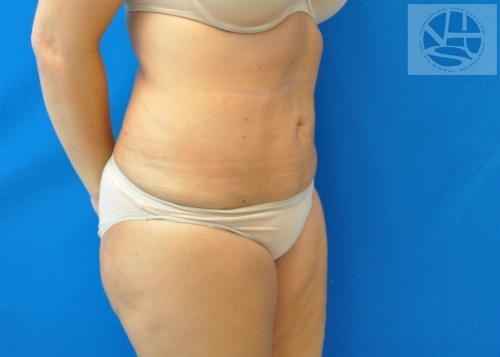 Liposuction Before and After | Little Lipo