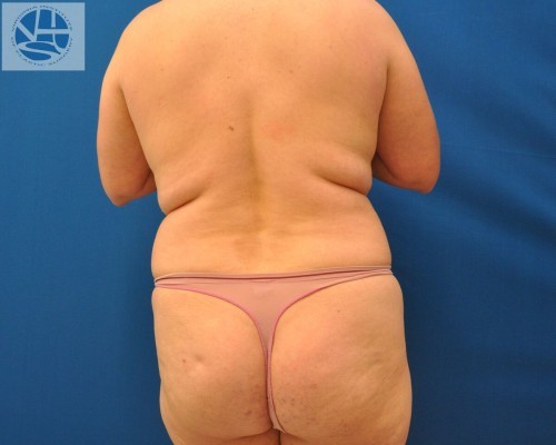 Liposuction Before and After | Little Lipo