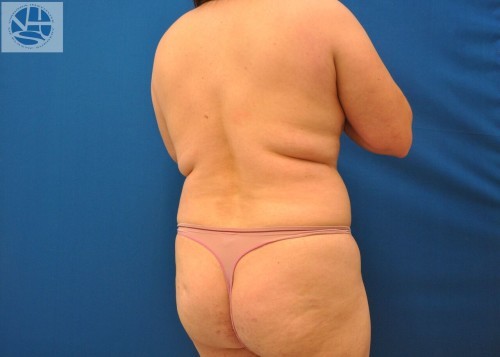 Liposuction Before and After | Little Lipo