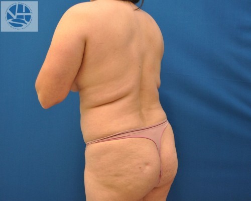 Liposuction Before and After | Little Lipo