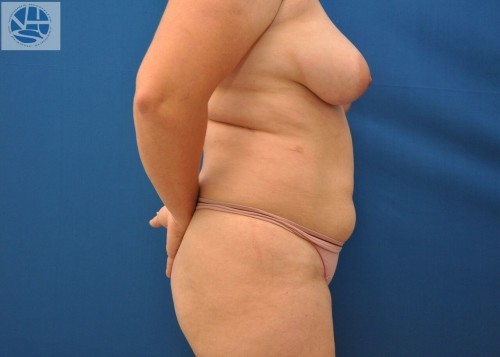 Liposuction Before and After | Little Lipo