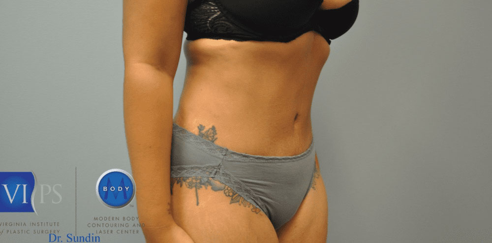 Chest Liposuction Richmond