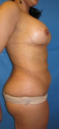 Liposuction Before and After | Little Lipo