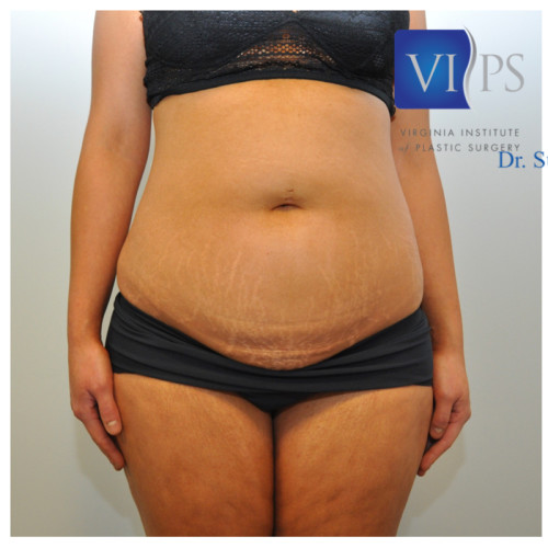 Laser Lipo Northern Virginia