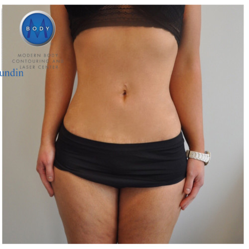 Liposuction Before and After | Little Lipo