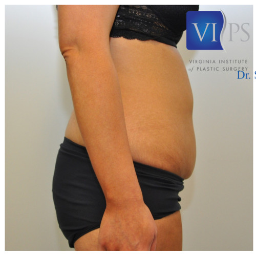 Liposuction Before and After | Little Lipo