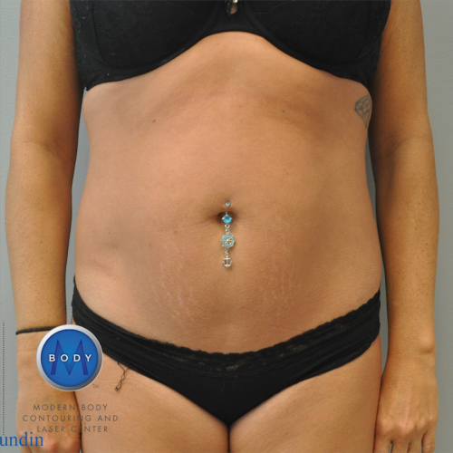 Liposuction Before and After | Little Lipo