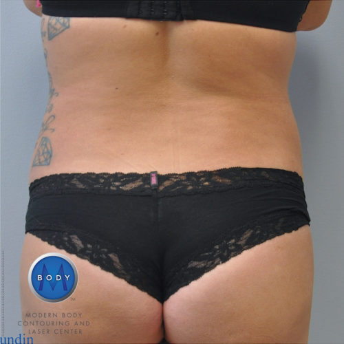 Liposuction Before and After | Little Lipo