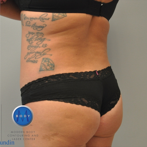 Liposuction Before and After | Little Lipo