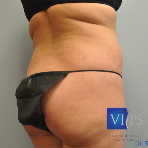 Liposuction Before and After | Little Lipo