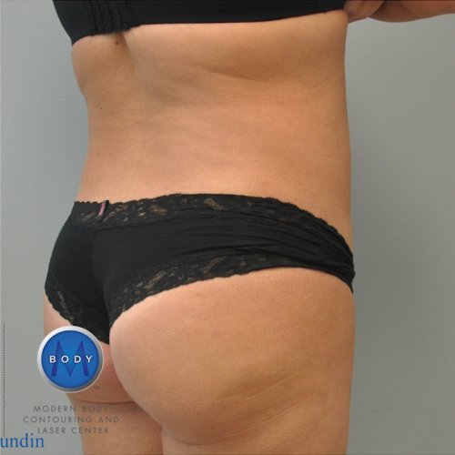 Liposuction Before and After | Little Lipo