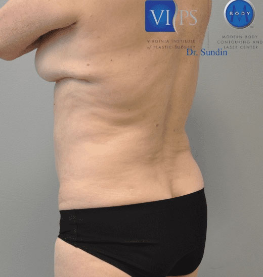 Liposuction Before and After | Little Lipo