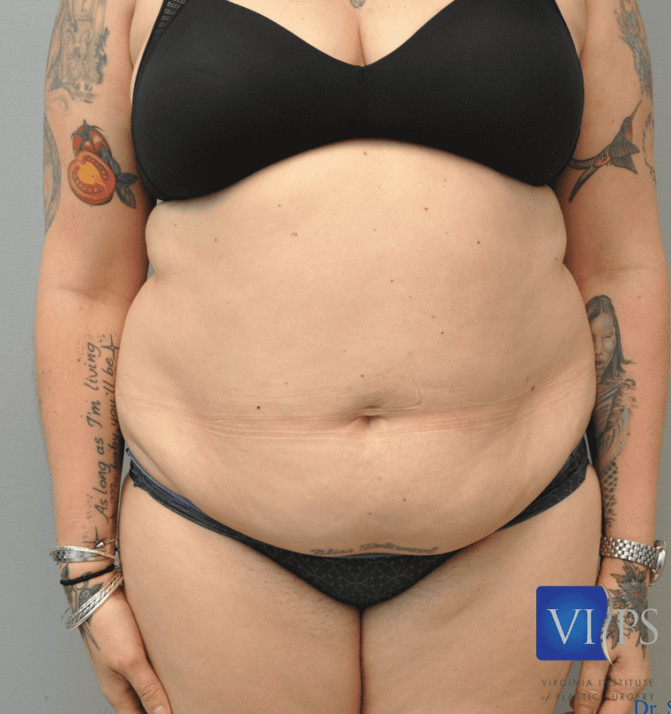 Chest Liposuction Richmond