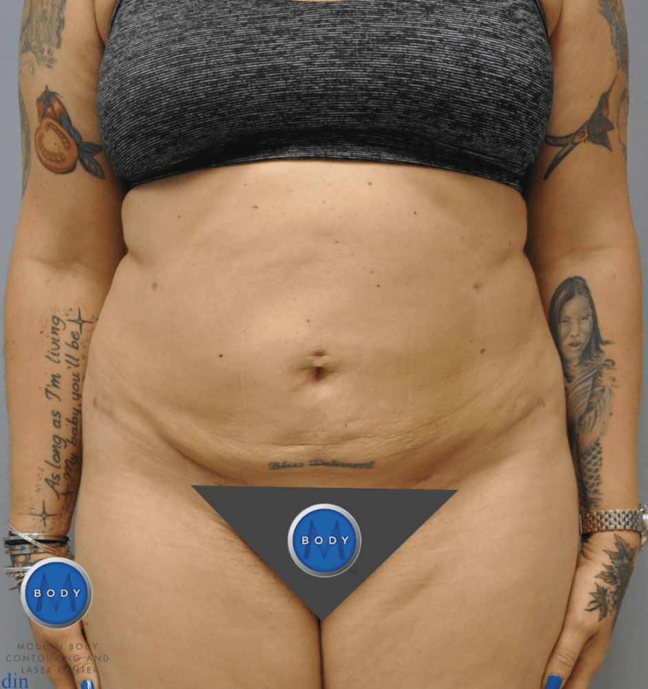 Liposuction Before and After | Little Lipo