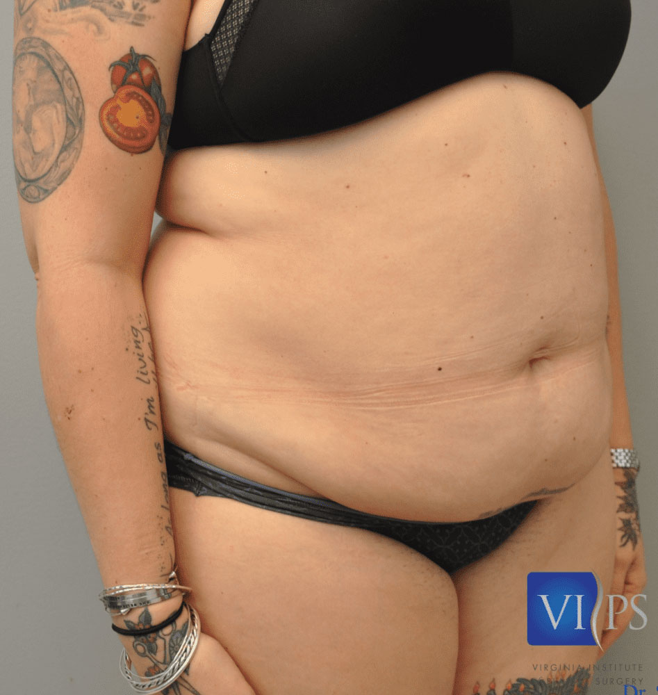 Liposuction Before and After | Little Lipo