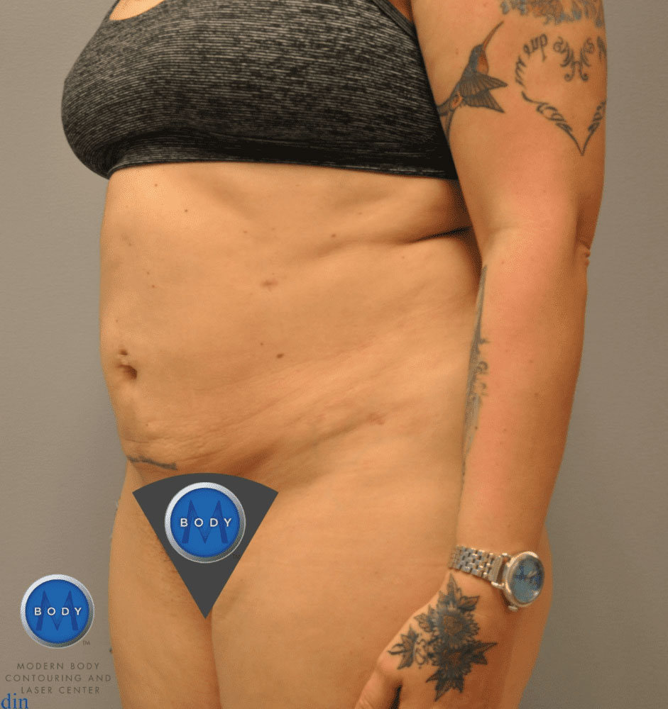 Liposuction Before and After | Little Lipo